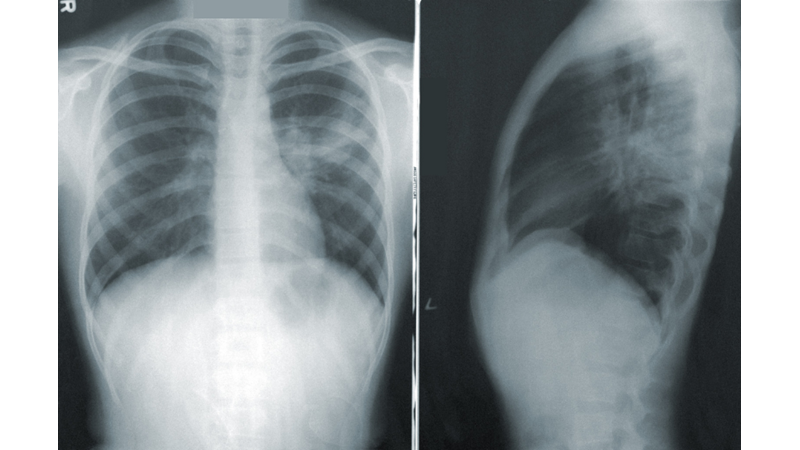 12 KASIM: DÜNYA ZATÜRRE (PNÖMONİ) GÜNÜ